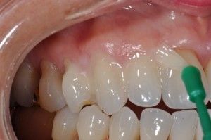 Preventative Dentistry in San Antonio, TX Dr. Precious Thomson. Thousand Oaks Dental. General, Cosmetic, Restorative, Preventative, Pediatric, Family Dentistry. Dentist in San Antonio Texas 78232