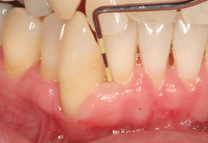 Preventative Dentistry in San Antonio, TX Dr. Precious Thomson. Thousand Oaks Dental. General, Cosmetic, Restorative, Preventative, Pediatric, Family Dentistry. Dentist in San Antonio Texas 78232