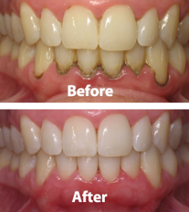 Periodontal Care in San Antonio, TX Dr. Precious Thomson. Thousand Oaks Dental. General, Cosmetic, Restorative, Preventative, Pediatric, Family Dentistry. Dentist in San Antonio Texas 78232