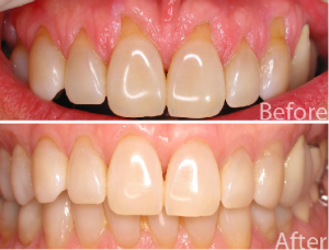 Periodontal Care in San Antonio, TX Dr. Precious Thomson. Thousand Oaks Dental. General, Cosmetic, Restorative, Preventative, Pediatric, Family Dentistry. Dentist in San Antonio Texas 78232