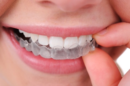 All About MTM® Clear Aligner in San Antonio, TX Dr. Thomson. Thousand Oaks Dental. General, Cosmetic, Restorative, Preventative, Pediatric, Family Dentistry. Dentist in San Antonio Texas 78232