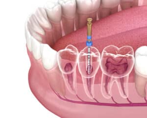 root canal therapy Thousand Oaks Dental dentist in San Antonio, TX