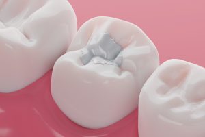 Dental Fillings San Antonio