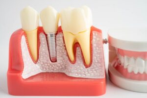 Dental Implants San Antonio
